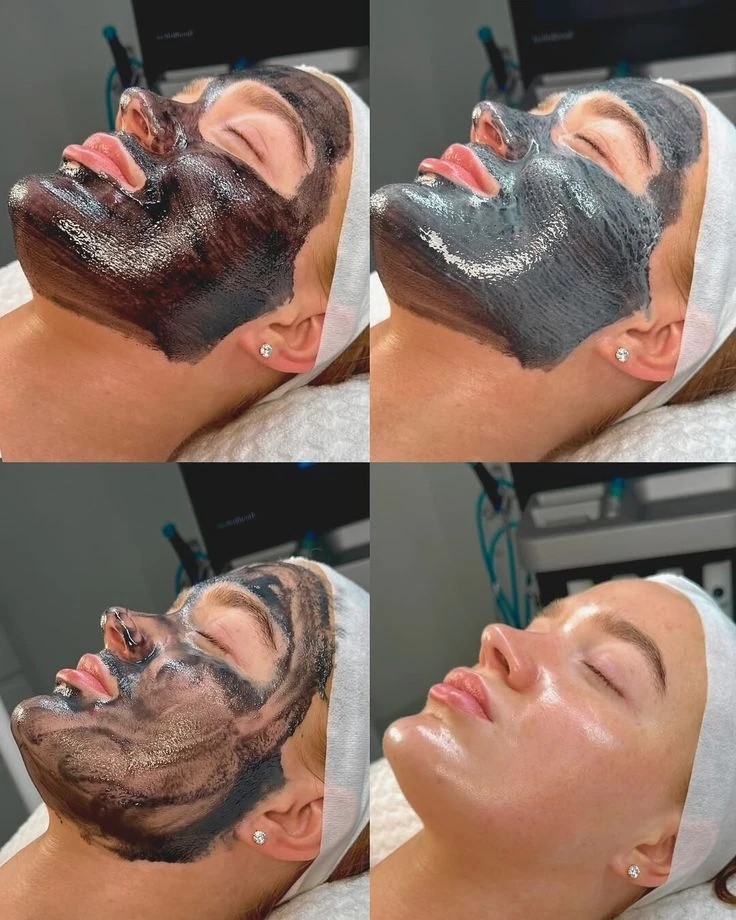 Карбоновый пилинг — результат процедуры