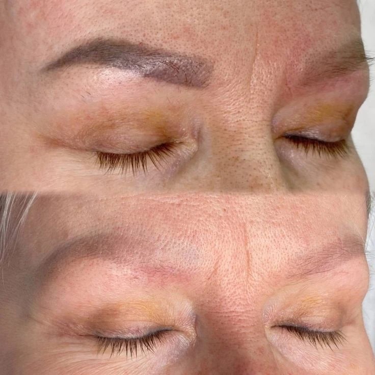 Удаление татуажа — до и после