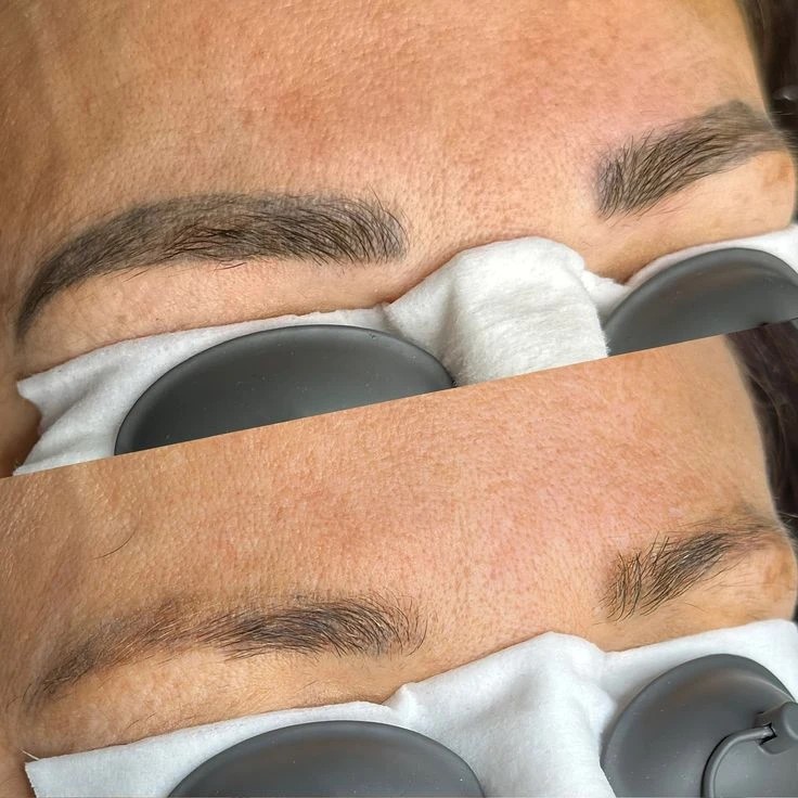 Удаление татуажа — до и после