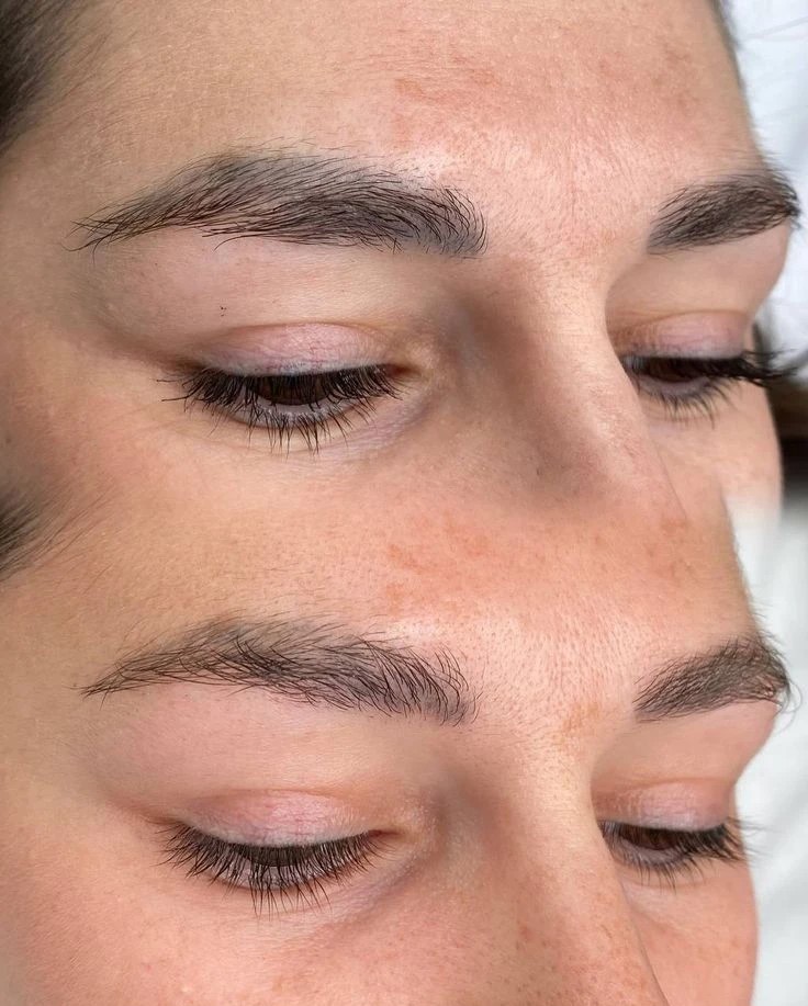 Удаление татуажа — до и после