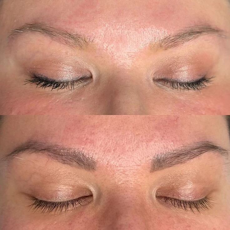 Удаление татуажа — до и после