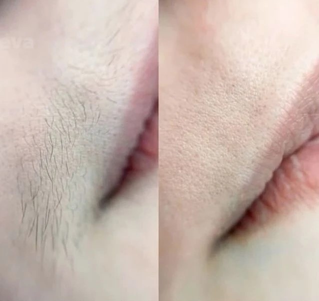 Результат женской депиляции