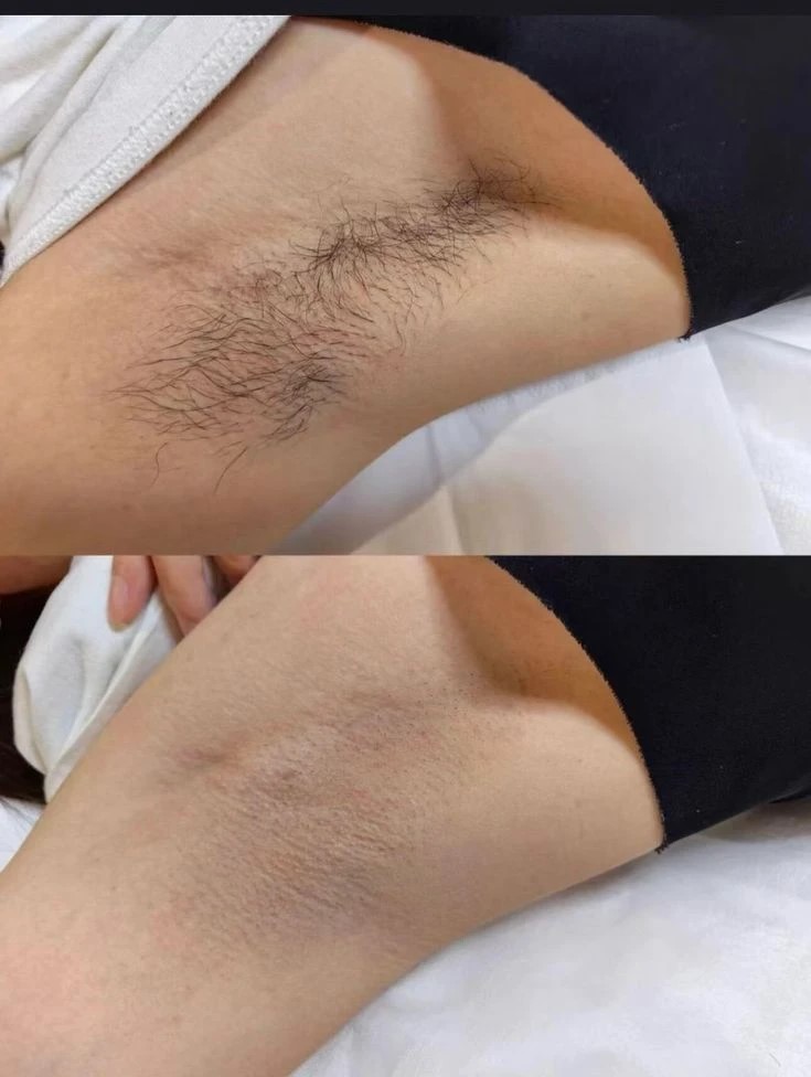 Результат женской депиляции